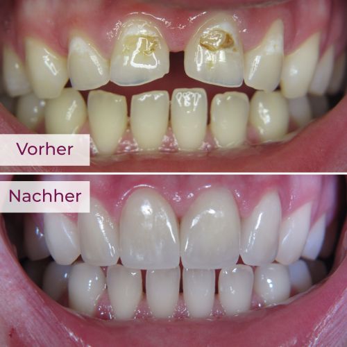 Veneers Rheda-Wiedenbrück
