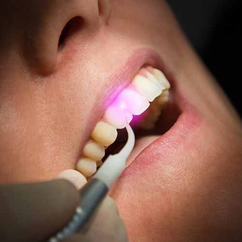 Parodontose­behandlung mit Laser Rheda-Wiedenbrueck