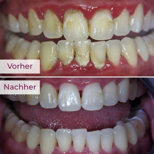 Parodontose­behandlung mit Laser Rheda-Wiedenbrück