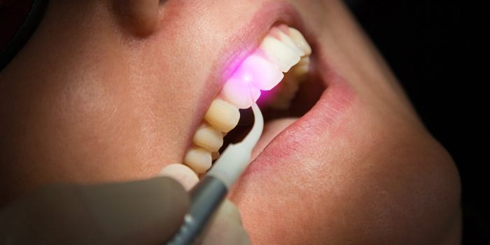 Parodontose­behandlung mit Laser Rheda-Wiedenbrück